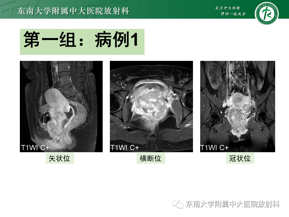 影像PPT - 【PPT】阴道病变影像诊断汇总-112 影像PPT - 【PPT】阴道病变影像诊断汇总-112