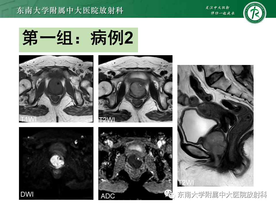影像PPT - 【PPT】阴道病变影像诊断汇总-115 影像PPT - 【PPT】阴道病变影像诊断汇总-115