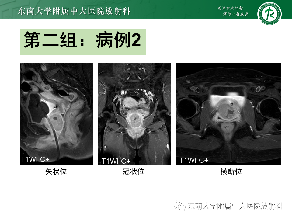 影像PPT - 【PPT】阴道病变影像诊断汇总-116 影像PPT - 【PPT】阴道病变影像诊断汇总-116