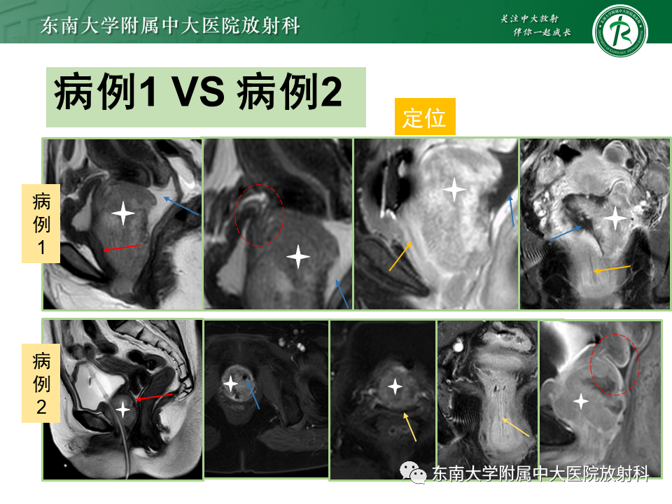 影像PPT - 【PPT】阴道病变影像诊断汇总-120 影像PPT - 【PPT】阴道病变影像诊断汇总-120