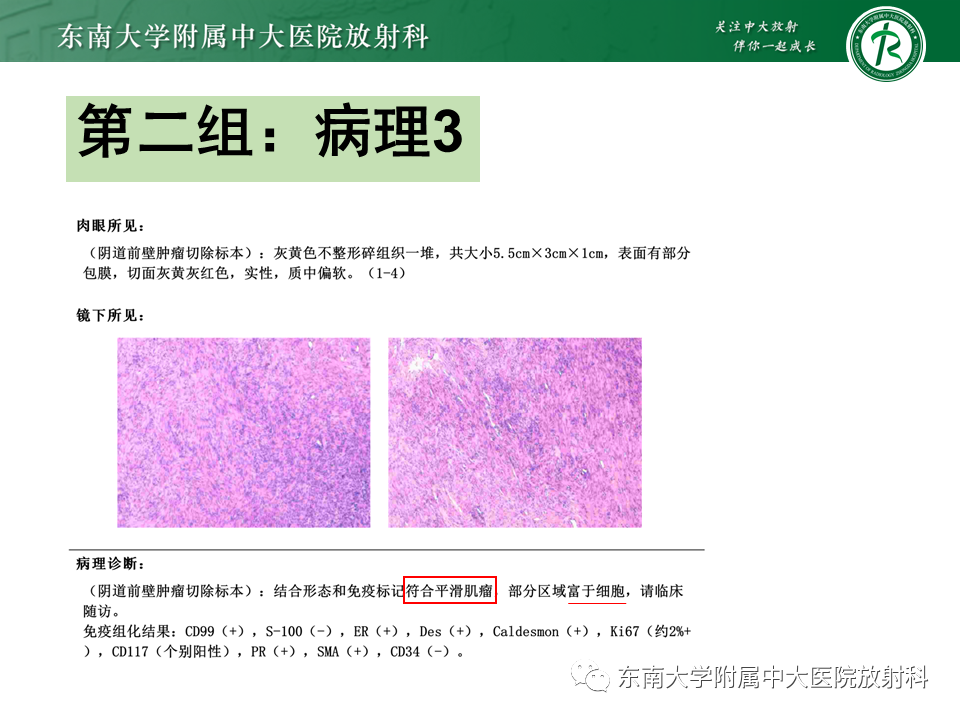 影像PPT - 【PPT】阴道病变影像诊断汇总-124 影像PPT - 【PPT】阴道病变影像诊断汇总-124