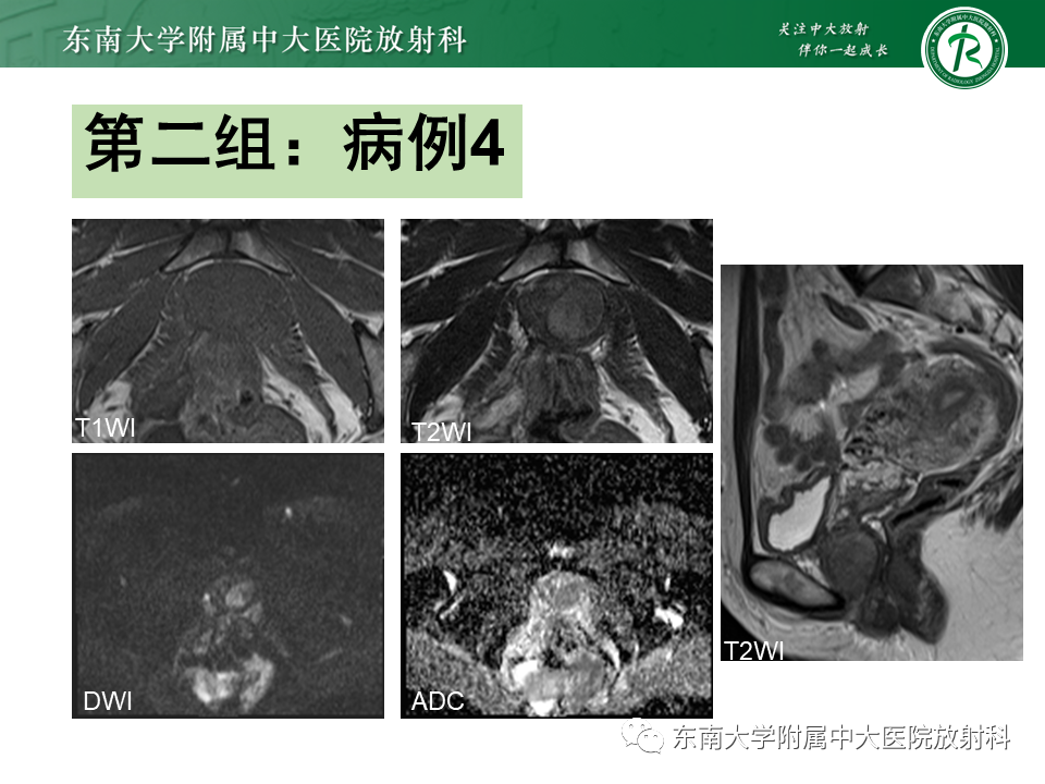 影像PPT - 【PPT】阴道病变影像诊断汇总-126 影像PPT - 【PPT】阴道病变影像诊断汇总-126