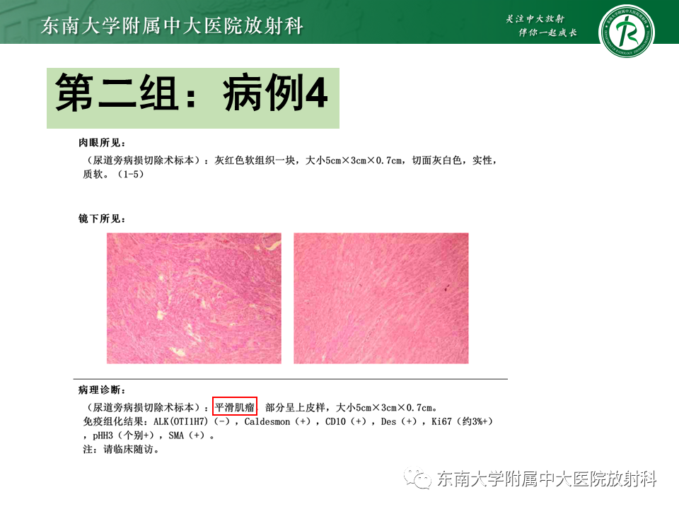 影像PPT - 【PPT】阴道病变影像诊断汇总-128 影像PPT - 【PPT】阴道病变影像诊断汇总-128