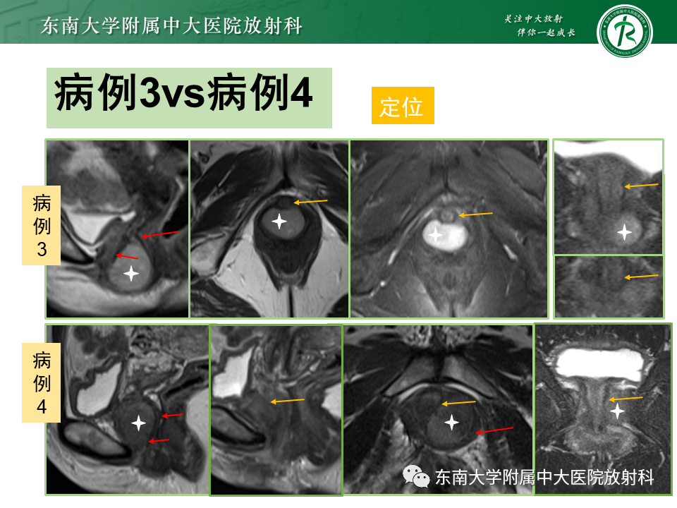 影像PPT - 【PPT】阴道病变影像诊断汇总-129 影像PPT - 【PPT】阴道病变影像诊断汇总-129