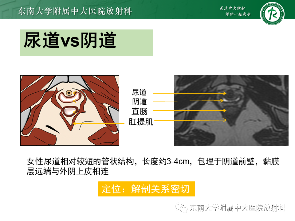 影像PPT - 【PPT】阴道病变影像诊断汇总-130 影像PPT - 【PPT】阴道病变影像诊断汇总-130