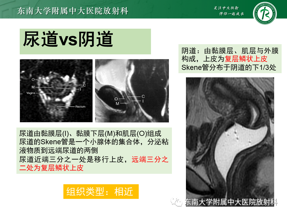 影像PPT - 【PPT】阴道病变影像诊断汇总-132 影像PPT - 【PPT】阴道病变影像诊断汇总-132