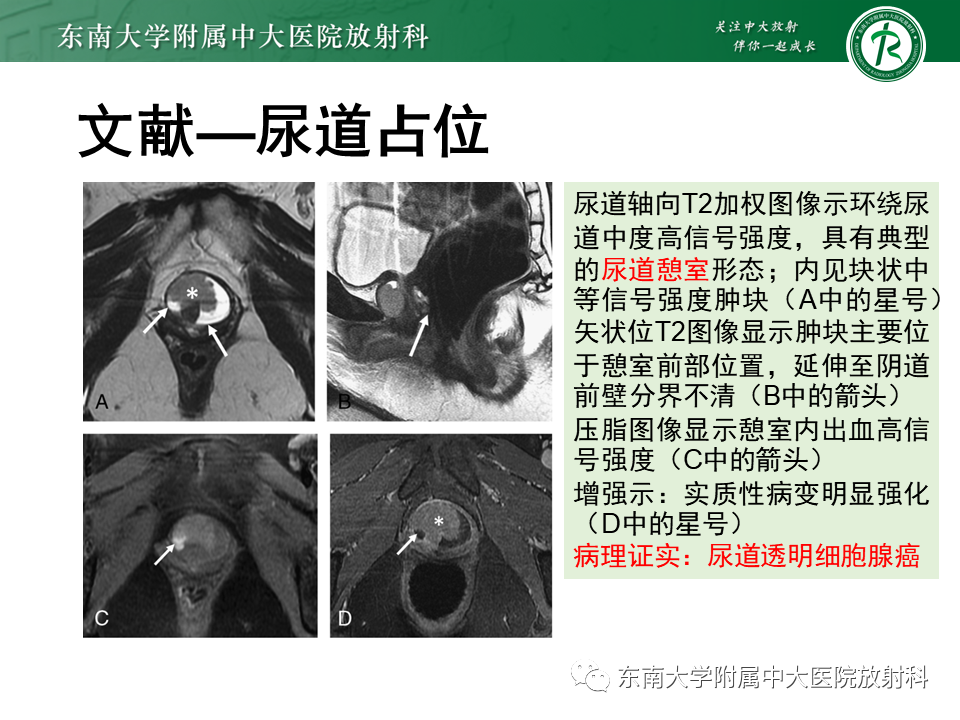影像PPT - 【PPT】阴道病变影像诊断汇总-133 影像PPT - 【PPT】阴道病变影像诊断汇总-133