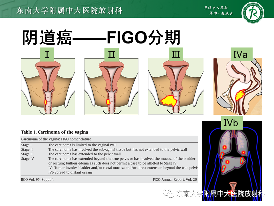 影像PPT - 【PPT】阴道病变影像诊断汇总-139 影像PPT - 【PPT】阴道病变影像诊断汇总-139