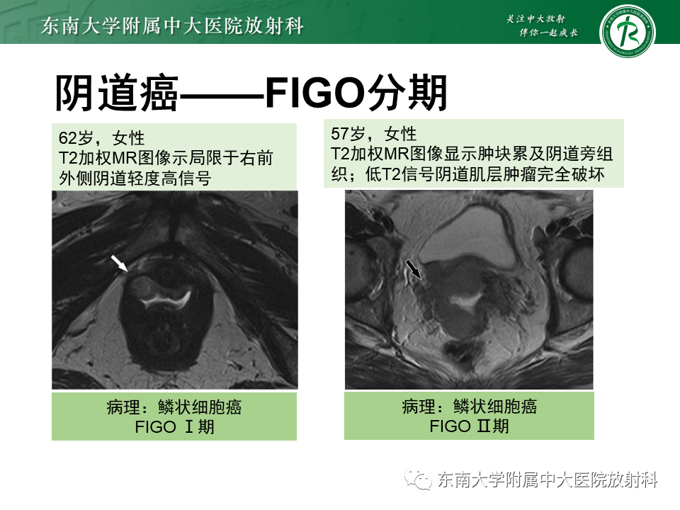 影像PPT - 【PPT】阴道病变影像诊断汇总-142 影像PPT - 【PPT】阴道病变影像诊断汇总-142