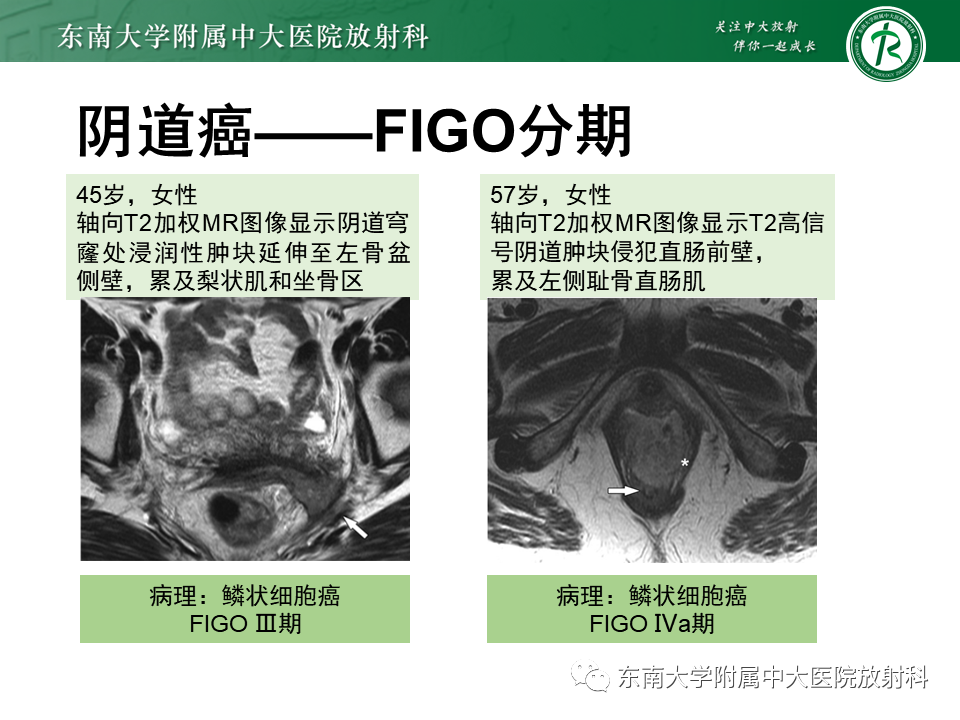 影像PPT - 【PPT】阴道病变影像诊断汇总-143 影像PPT - 【PPT】阴道病变影像诊断汇总-143