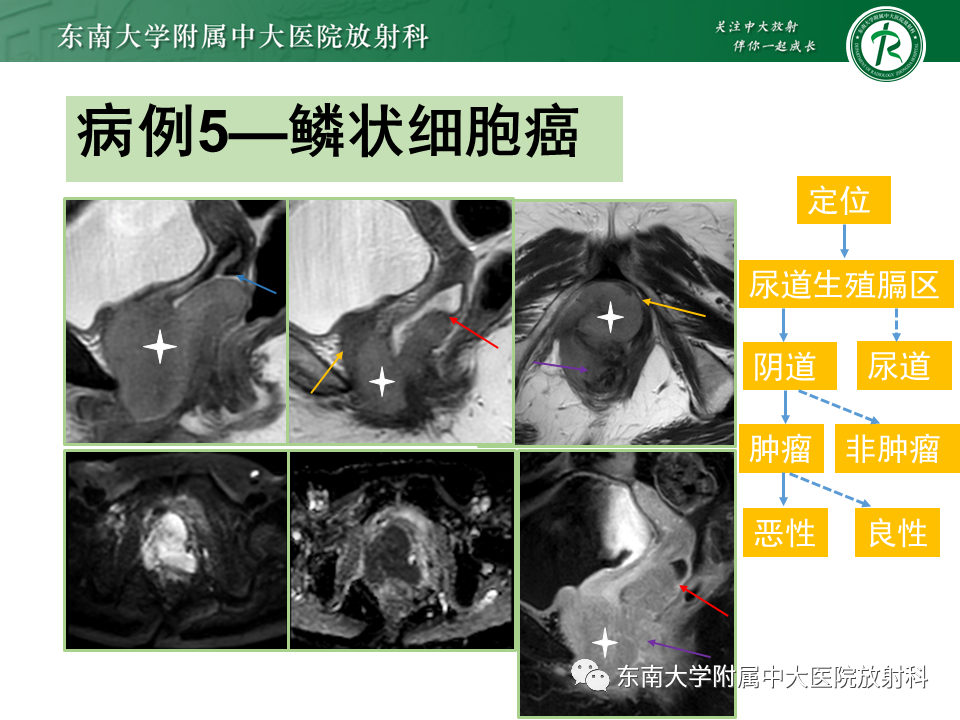 影像PPT - 【PPT】阴道病变影像诊断汇总-145 影像PPT - 【PPT】阴道病变影像诊断汇总-145
