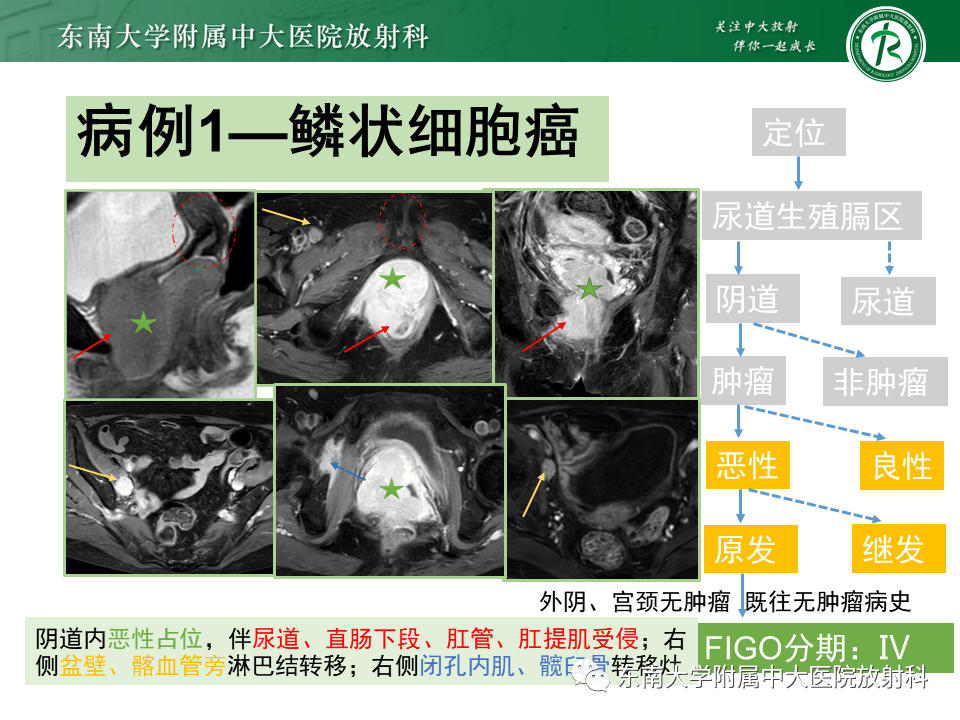 影像PPT - 【PPT】阴道病变影像诊断汇总-146 影像PPT - 【PPT】阴道病变影像诊断汇总-146