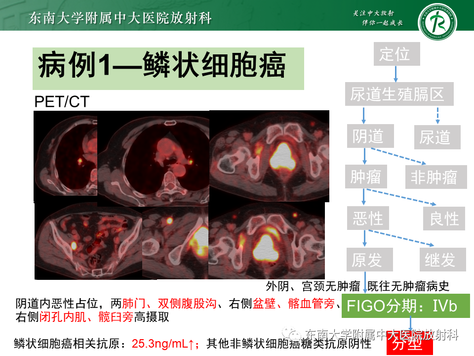 影像PPT - 【PPT】阴道病变影像诊断汇总-147 影像PPT - 【PPT】阴道病变影像诊断汇总-147