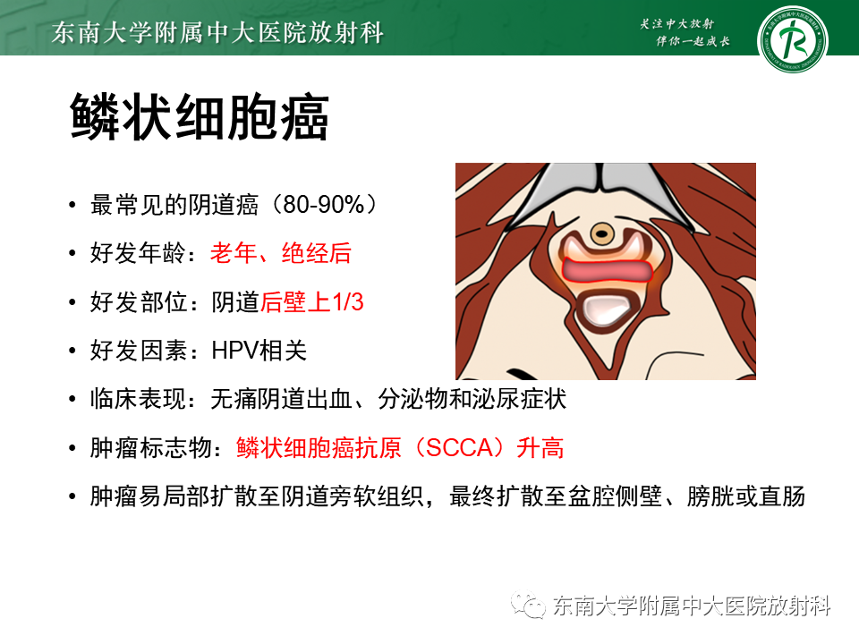 影像PPT - 【PPT】阴道病变影像诊断汇总-149 影像PPT - 【PPT】阴道病变影像诊断汇总-149