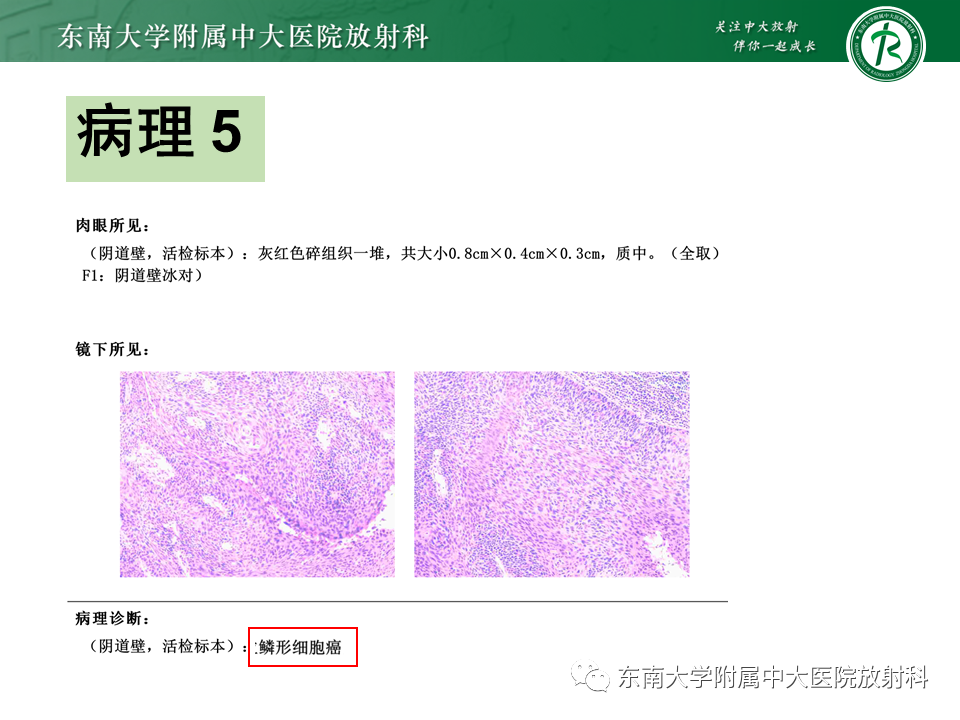 影像PPT - 【PPT】阴道病变影像诊断汇总-148 影像PPT - 【PPT】阴道病变影像诊断汇总-148