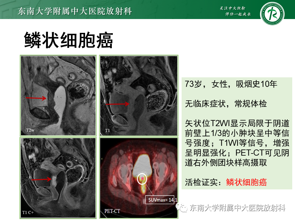 影像PPT - 【PPT】阴道病变影像诊断汇总-150 影像PPT - 【PPT】阴道病变影像诊断汇总-150