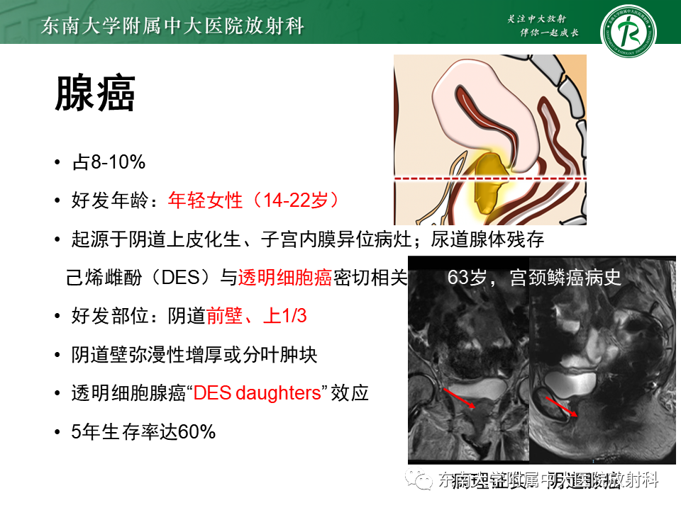影像PPT - 【PPT】阴道病变影像诊断汇总-151 影像PPT - 【PPT】阴道病变影像诊断汇总-151