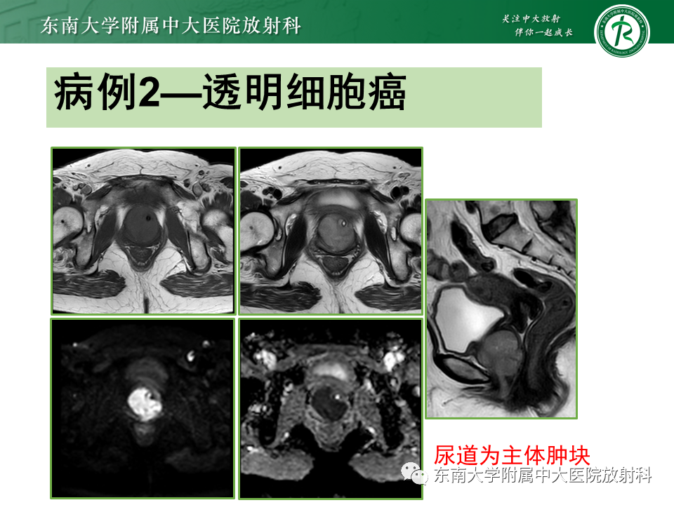 影像PPT - 【PPT】阴道病变影像诊断汇总-152 影像PPT - 【PPT】阴道病变影像诊断汇总-152