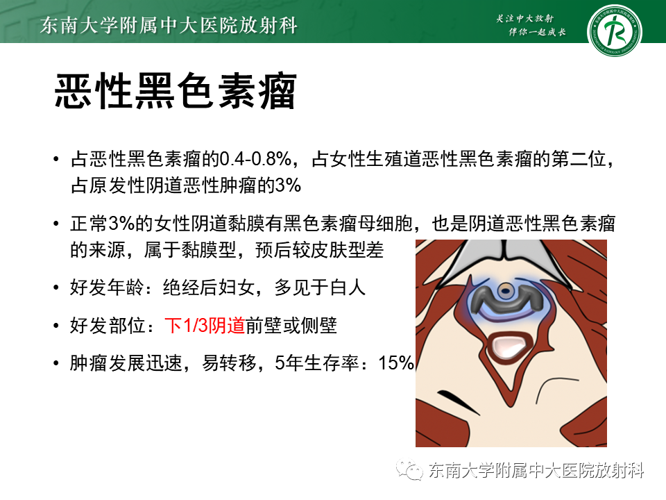 影像PPT - 【PPT】阴道病变影像诊断汇总-157 影像PPT - 【PPT】阴道病变影像诊断汇总-157
