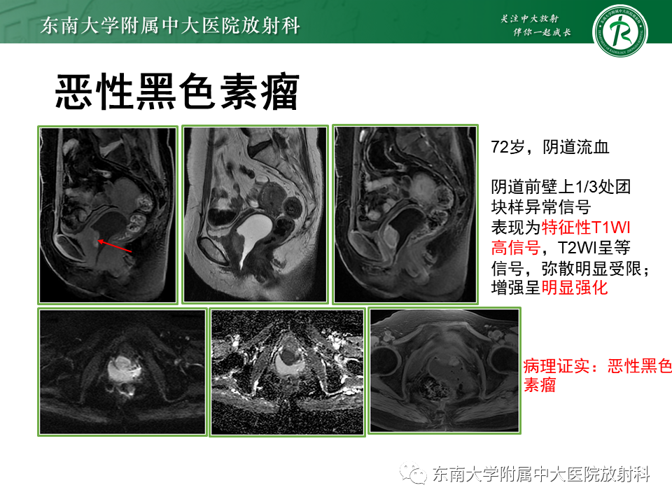 影像PPT - 【PPT】阴道病变影像诊断汇总-158 影像PPT - 【PPT】阴道病变影像诊断汇总-158