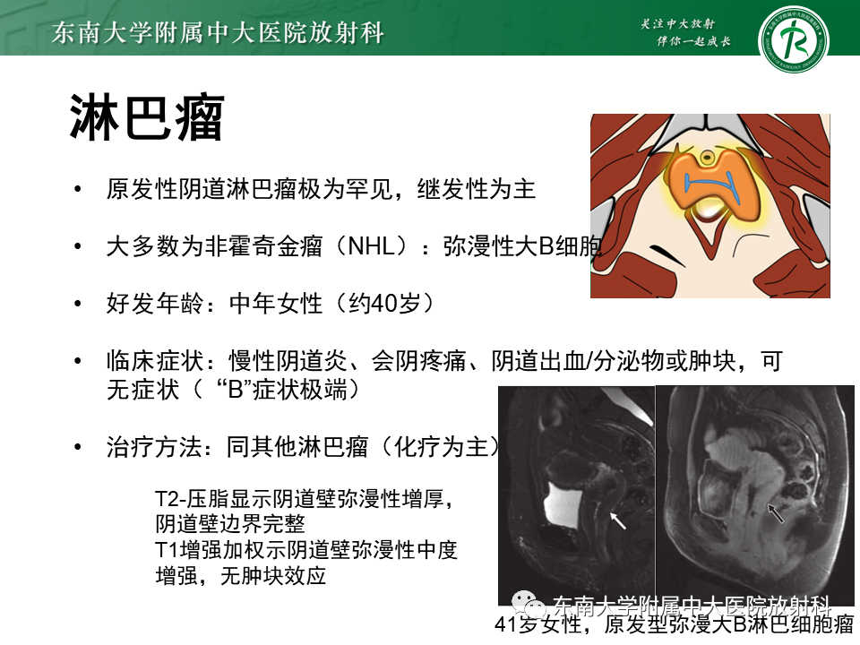 影像PPT - 【PPT】阴道病变影像诊断汇总-161 影像PPT - 【PPT】阴道病变影像诊断汇总-161
