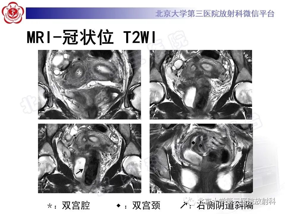 影像PPT - 【PPT】阴道病变影像诊断汇总-169 影像PPT - 【PPT】阴道病变影像诊断汇总-169
