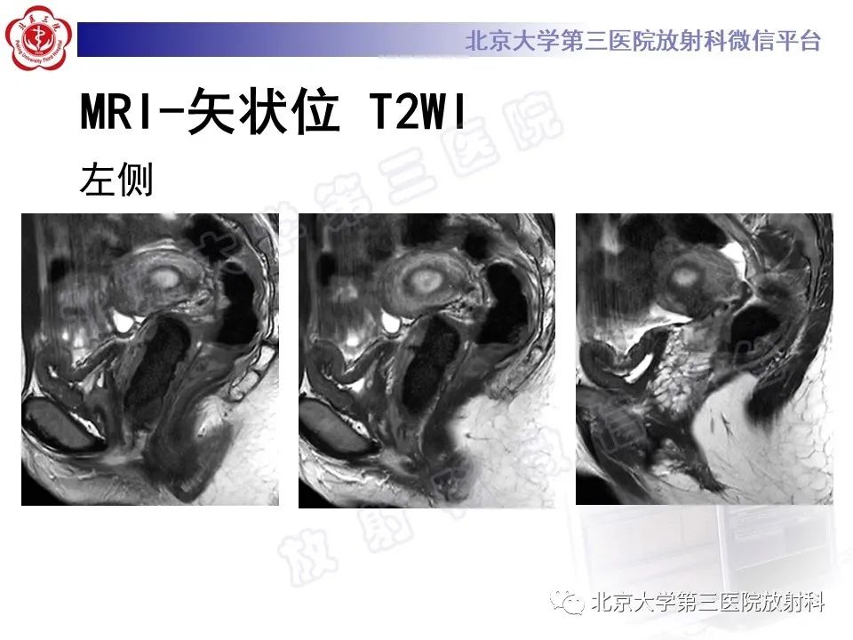 影像PPT - 【PPT】阴道病变影像诊断汇总-171 影像PPT - 【PPT】阴道病变影像诊断汇总-171