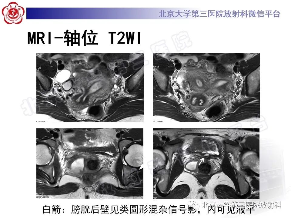 影像PPT - 【PPT】阴道病变影像诊断汇总-172 影像PPT - 【PPT】阴道病变影像诊断汇总-172