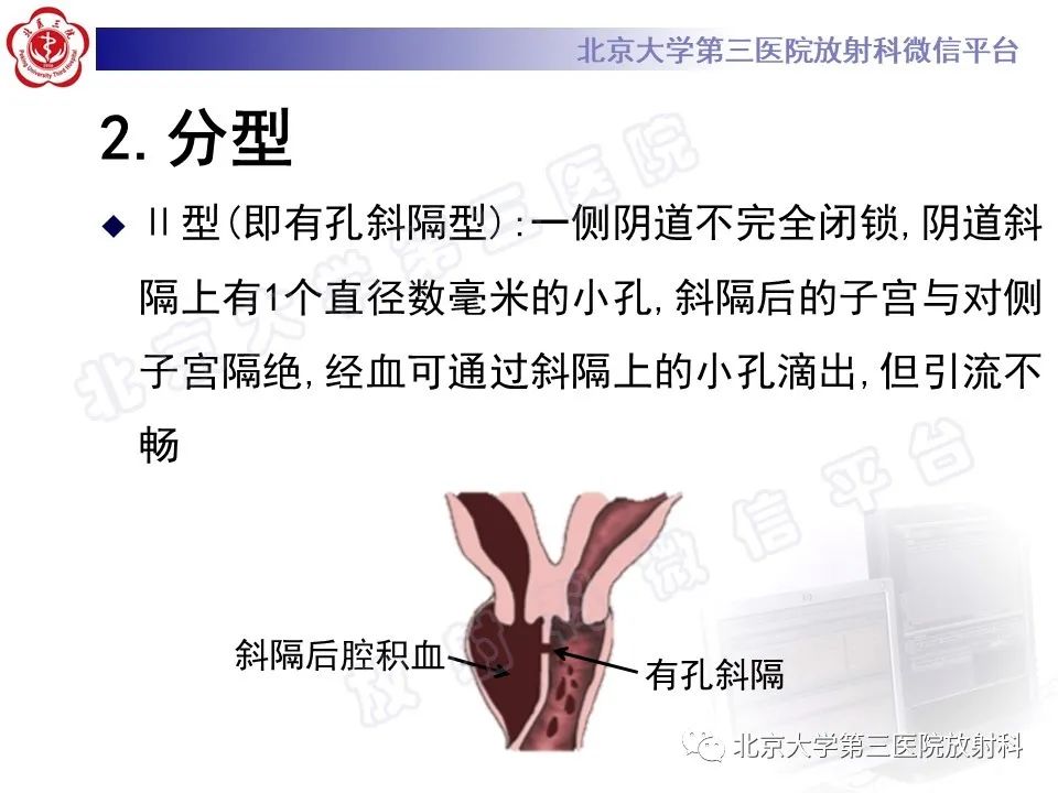 影像PPT - 【PPT】阴道病变影像诊断汇总-185 影像PPT - 【PPT】阴道病变影像诊断汇总-185