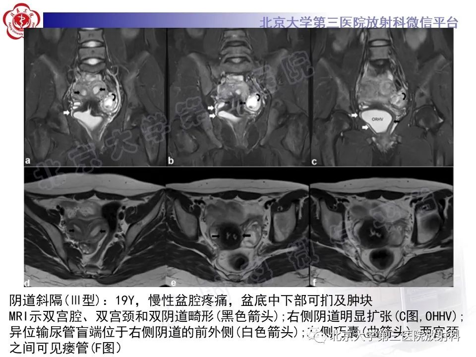 影像PPT - 【PPT】阴道病变影像诊断汇总-187 影像PPT - 【PPT】阴道病变影像诊断汇总-187
