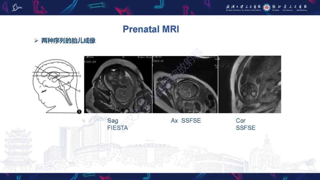 影像PPT - 【PPT】先天性唇腭裂影像诊断-4