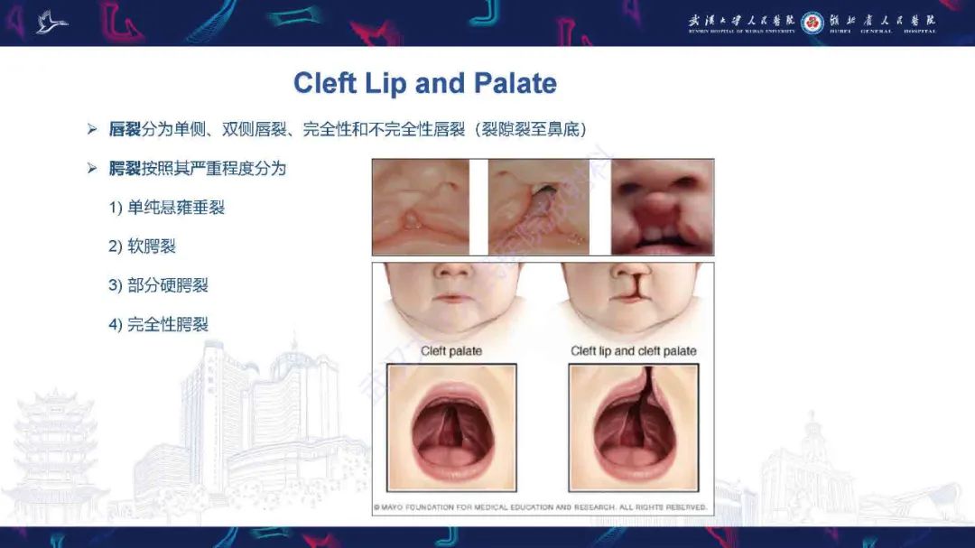 影像PPT - 【PPT】先天性唇腭裂影像诊断-6