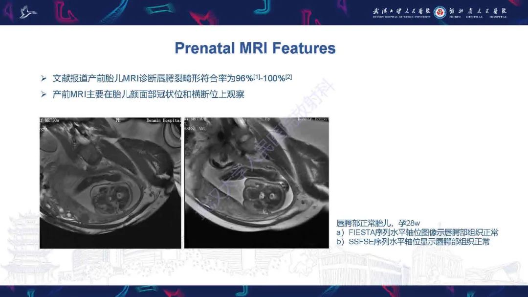 影像PPT - 【PPT】先天性唇腭裂影像诊断-12