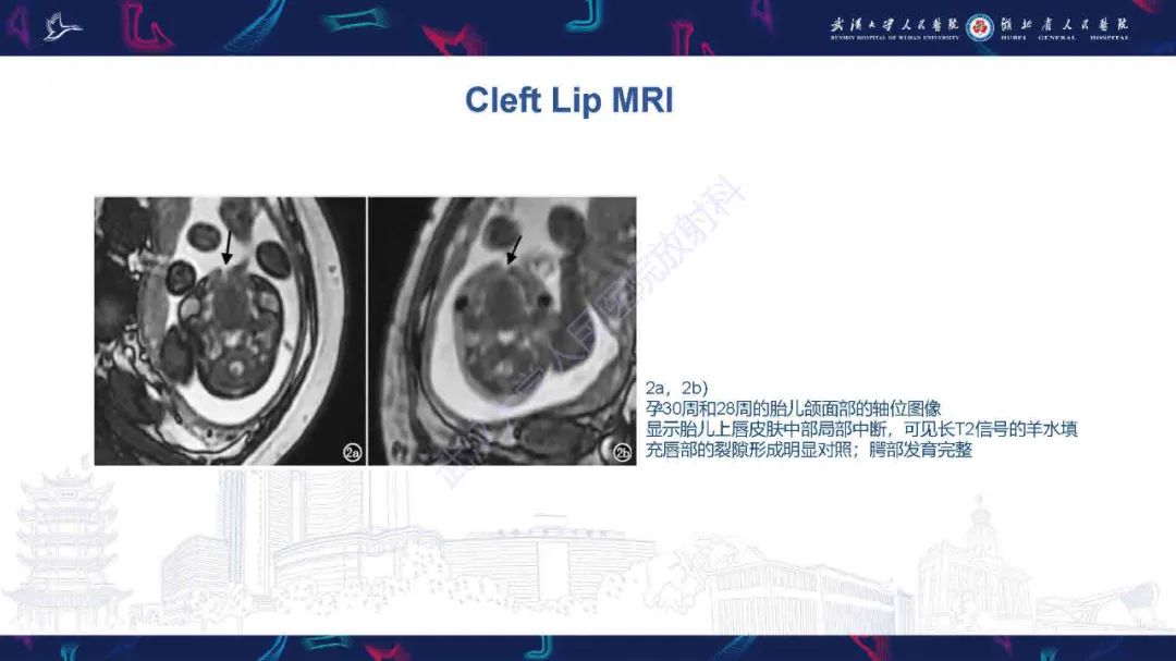 影像PPT - 【PPT】先天性唇腭裂影像诊断-13