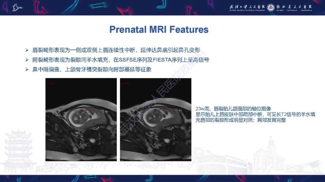 影像PPT - 【PPT】先天性唇腭裂影像诊断-14