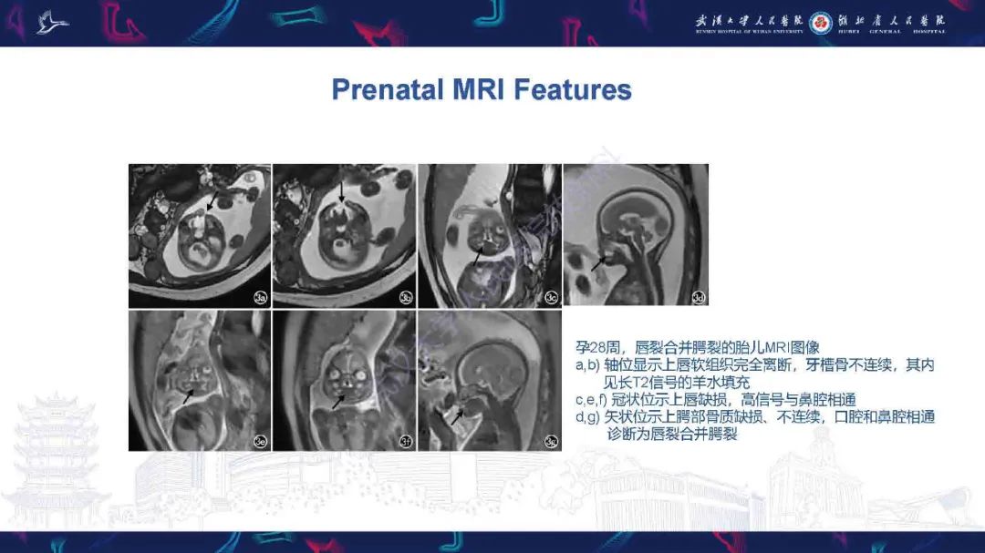 影像PPT - 【PPT】先天性唇腭裂影像诊断-15