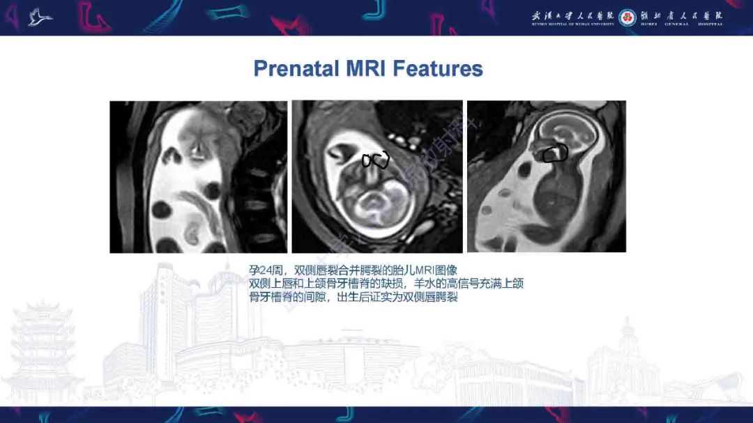 影像PPT - 【PPT】先天性唇腭裂影像诊断-16