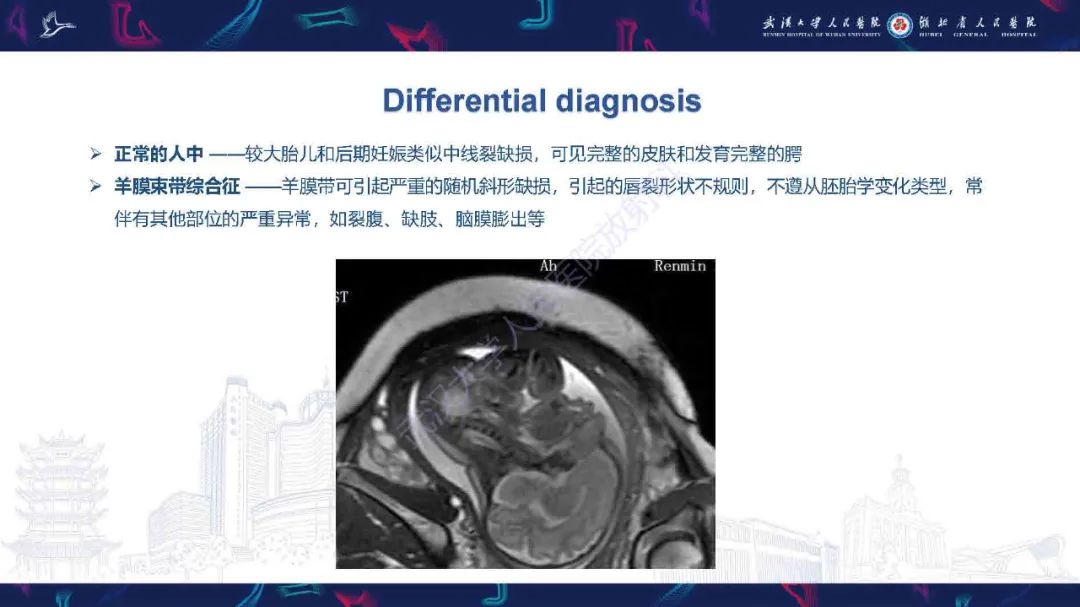 影像PPT - 【PPT】先天性唇腭裂影像诊断-17