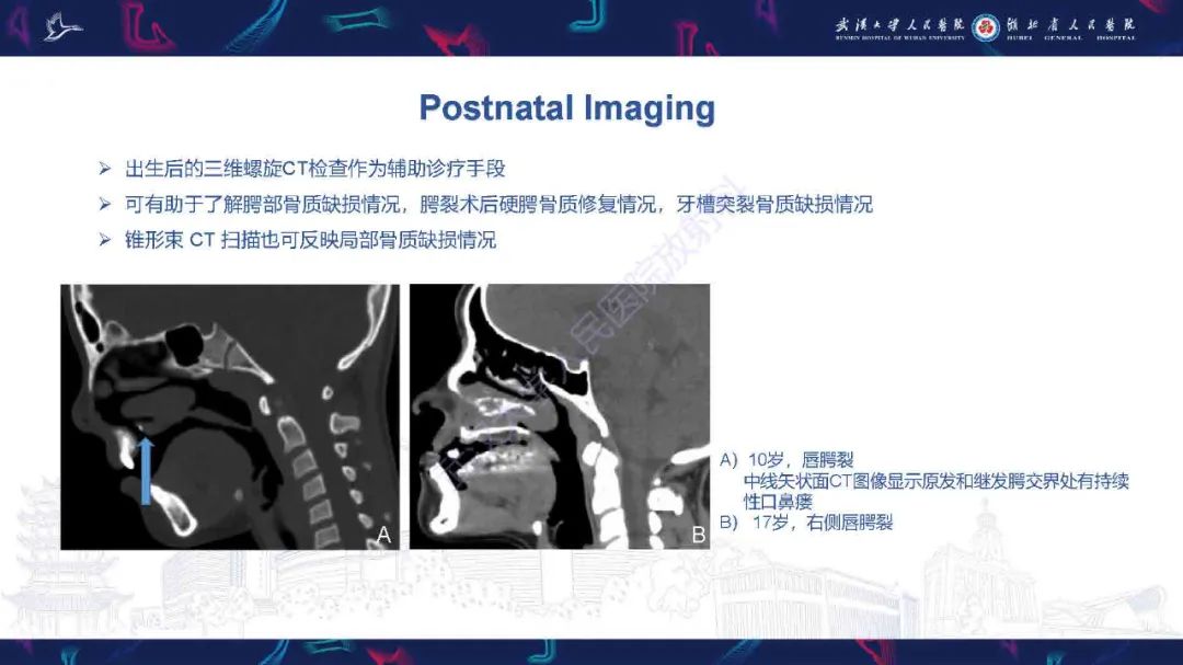影像PPT - 【PPT】先天性唇腭裂影像诊断-18