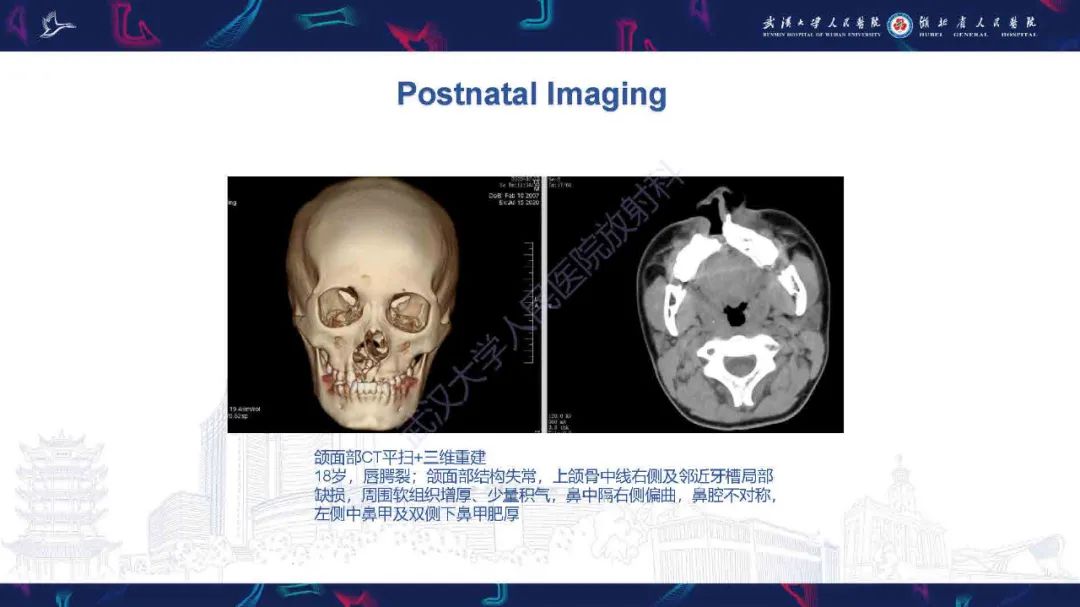 影像PPT - 【PPT】先天性唇腭裂影像诊断-19