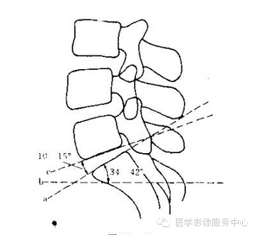 影像PPT - 容易忽略的十个腰椎MRI的征象-16 影像PPT - 容易忽略的十个腰椎MRI的征象-16