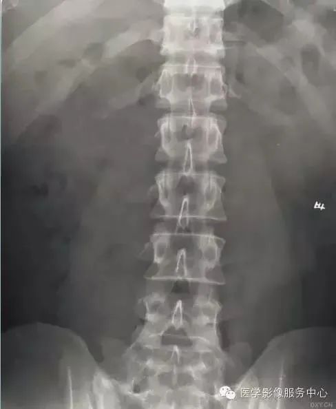 影像PPT - 容易忽略的十个腰椎MRI的征象-17 影像PPT - 容易忽略的十个腰椎MRI的征象-17