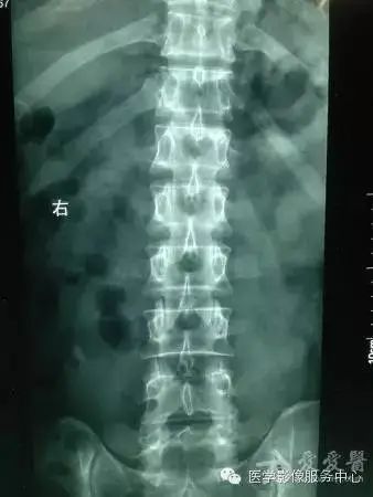 影像PPT - 容易忽略的十个腰椎MRI的征象-19 影像PPT - 容易忽略的十个腰椎MRI的征象-19