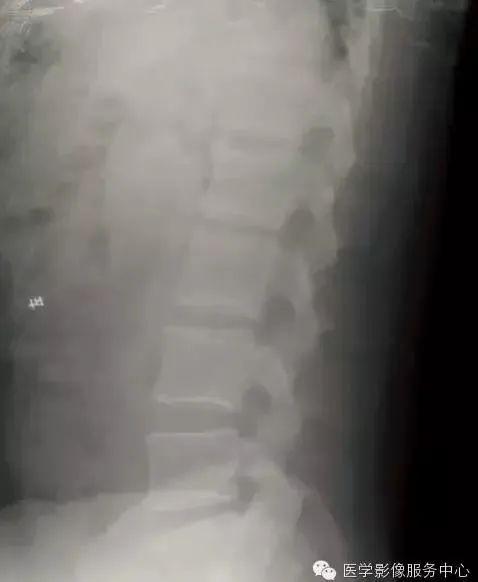 影像PPT - 容易忽略的十个腰椎MRI的征象-18 影像PPT - 容易忽略的十个腰椎MRI的征象-18