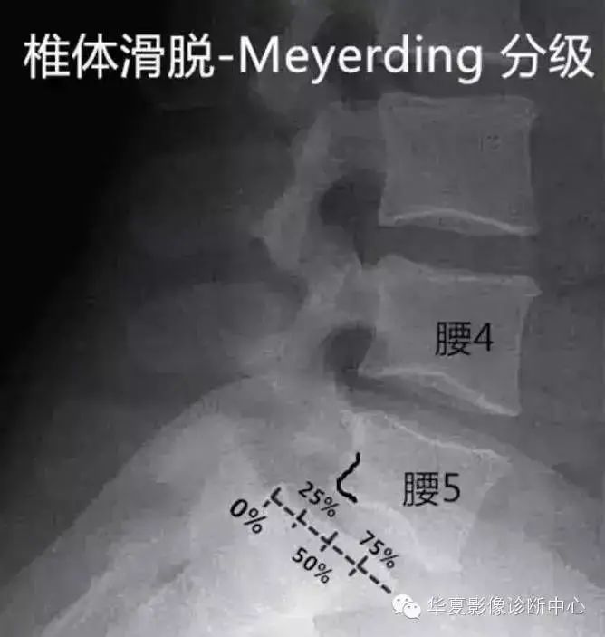 影像PPT - 容易忽略的十个腰椎MRI的征象-21 影像PPT - 容易忽略的十个腰椎MRI的征象-21