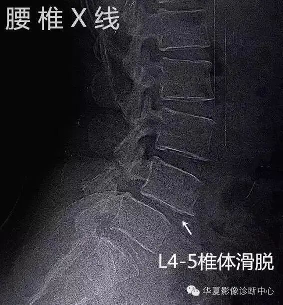 影像PPT - 容易忽略的十个腰椎MRI的征象-25 影像PPT - 容易忽略的十个腰椎MRI的征象-25