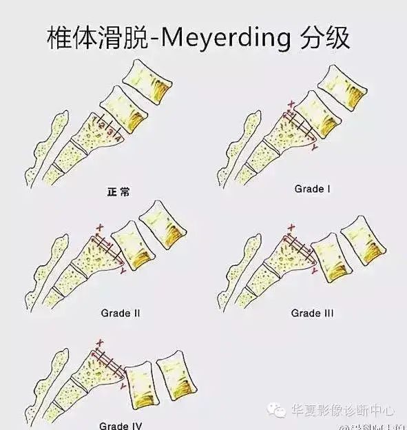 影像PPT - 容易忽略的十个腰椎MRI的征象-24 影像PPT - 容易忽略的十个腰椎MRI的征象-24