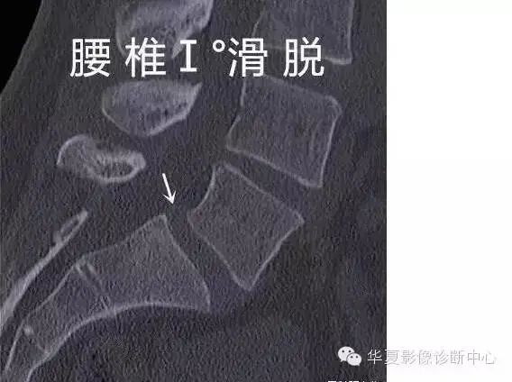 影像PPT - 容易忽略的十个腰椎MRI的征象-26 影像PPT - 容易忽略的十个腰椎MRI的征象-26
