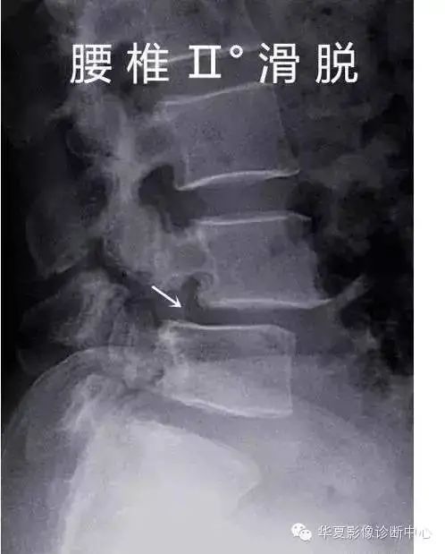 影像PPT - 容易忽略的十个腰椎MRI的征象-27 影像PPT - 容易忽略的十个腰椎MRI的征象-27