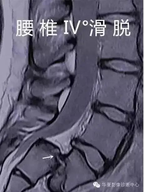 影像PPT - 容易忽略的十个腰椎MRI的征象-29 影像PPT - 容易忽略的十个腰椎MRI的征象-29